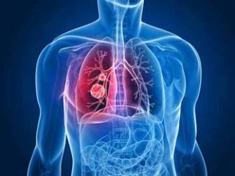 Akciğer Kanserine Neden Olan Çevresel Faktörler