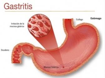 Gastrit Nedir Kısaca Bilgi