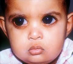Göz Bebeği Hastalıkları